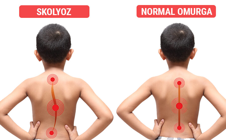 Skolyoz Nedir? Skolyoz Korsesi Nedir? Bursa