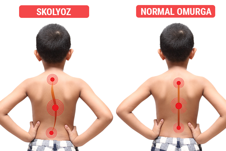 SKOLYOZ BURSA