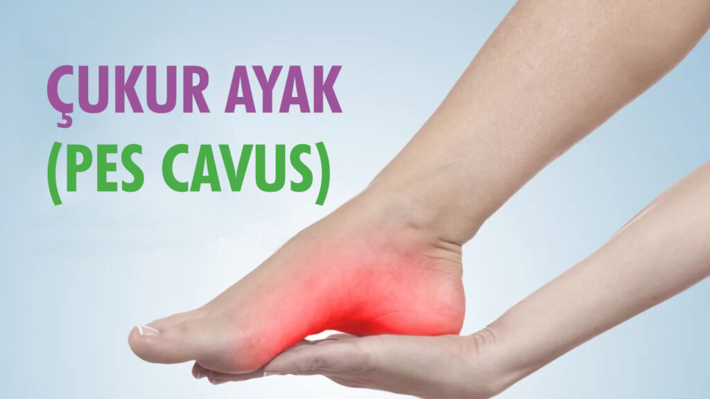 PES CAVUS (YÜKSEK TABAN)
