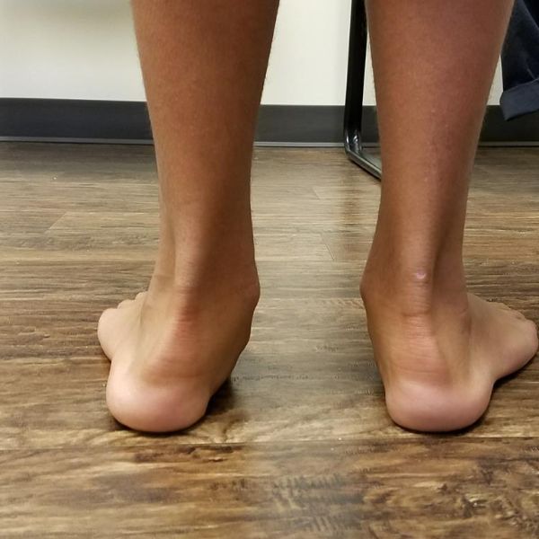 Düz Taban (Pesplanus)